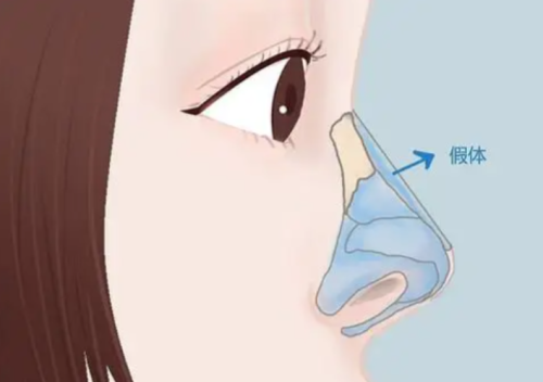 美植挺和立秀膨体哪个更好，谁才是隆鼻界的真·顶流？