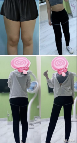 哈尔滨瑞丽吸脂价格表：8000-10000元就能拿下，教你用最少的钱，卷出最绝的身材！