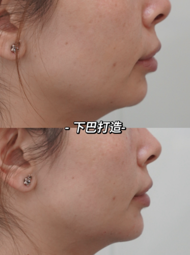 自体脂肪下巴填充价格：8000 元搞定 “小翘下巴”