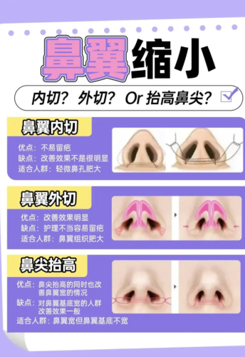 缩鼻翼手术多少钱左右?从 5000 到 3 万,价差里的门道全解析