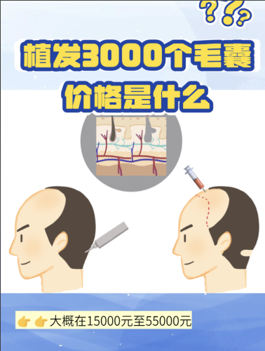 阜阳市人民医院植发手术价格：5元/单位真的划算吗？