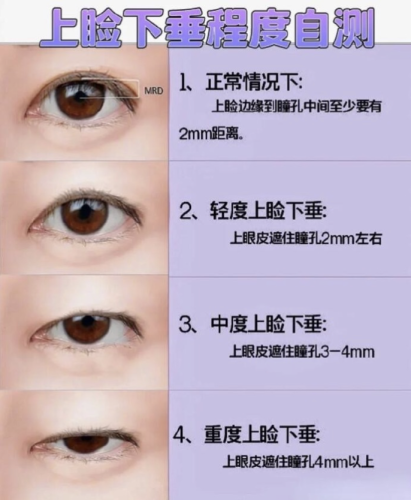 上睑下垂成年了还有必要手术吗？附2份对比表+3个真人血泪史，看前后对比