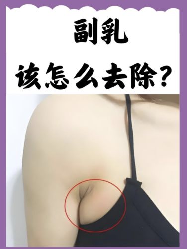 副乳抽脂好还是切除好?3类真人案例+2张对比表,整形外科医生揭秘真相