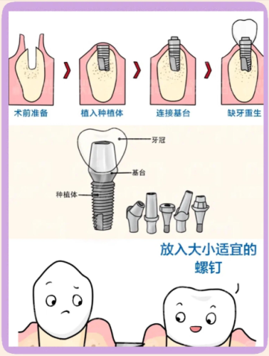 广州中西医结合医院种植牙怎么样?中医护养+数字化种植双buff,真实案例+2025 价表揭秘