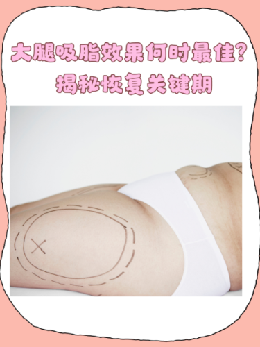 大腿吸脂和臀部吸脂能一起做吗？能一起做！但得满足3个硬条件
