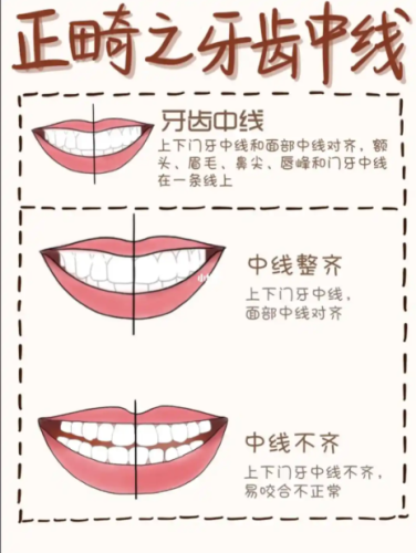 中山三院牙齿正畸费用真相大揭秘,不同牙套价差2万+