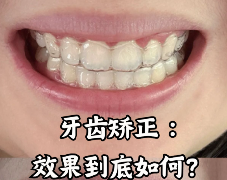 中山三院牙齿矫正怎么样?三甲硬核实力+2025低价表,学生党也能冲