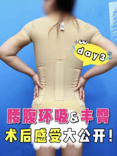 丰臀和腰腹环吸要一起做还是分开做比较好？医生揭秘：3类人适合同做，2类人必分开