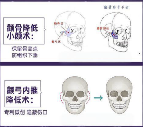 颧弓内推和颧骨内推一样吗?90%的人搞混3个核心差异