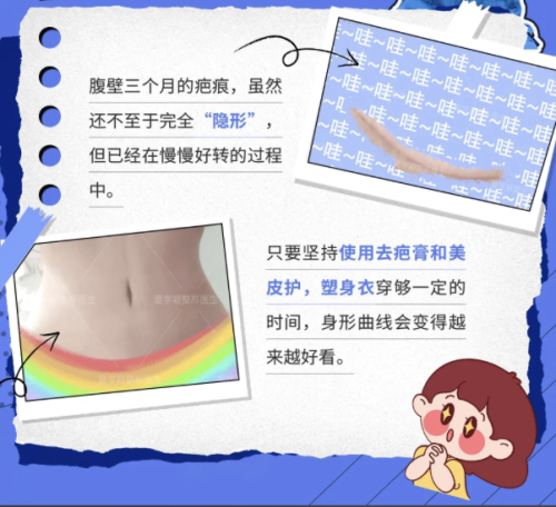 做腹壁整形要多久才能恢复呢?4个阶段+3个影响因素,真人案例实证