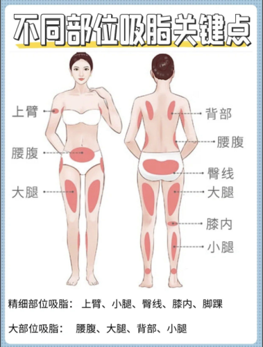 肚子抽脂和大腿抽脂哪个安全些?没有 “更安全”,只有 “更适配”
