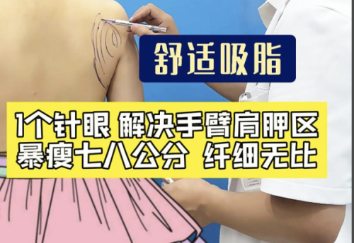 肩胛骨吸脂在哪个位置?2025精准定位指南+避坑攻略,告别 “虎背熊腰”