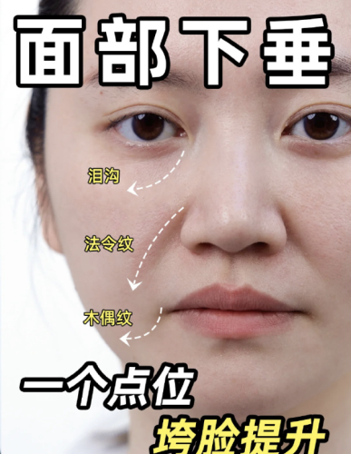 玻尿酸填充泪沟和法令纹有副作用吗？2025真实风险+避坑指南，看完再决定