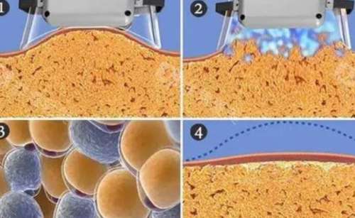 大腿吸脂dm03.jpg 大腿吸脂dm03.jpg