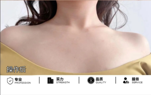 锁骨整形大概多少钱？主流方案价目表：不同需求对应不同预算