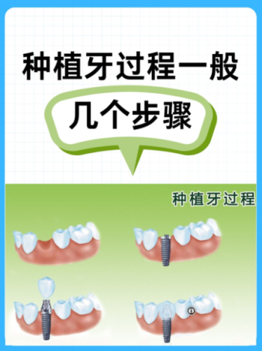 临安种牙哪里好?从技术到售后扒透（附高龄种牙干货）