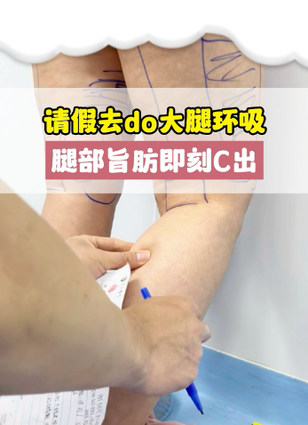 环吸腿部脂肪多少钱？2张表帮你精准匹配预算，避开价格陷阱