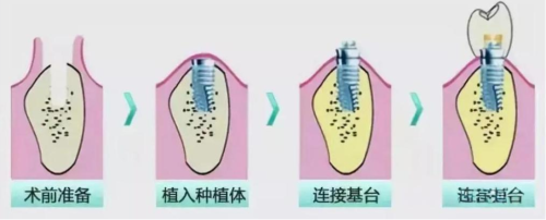 武汉种牙医院排名：4类种牙机构对比，哪类适合你？
