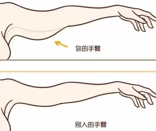 蝴蝶袖手臂吸脂会反弹吗？维持状态长短并不是单一因素决定的结果