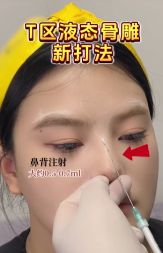 骨雕鼻和线雕鼻的区别：99%求美者分不清的8大核心差异，一篇说透怎么选