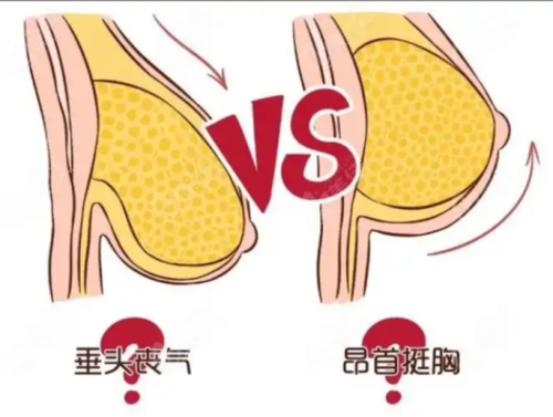 人工韧带乳房提升术和悬吊术区别：是医美界的技术之争还是精准之选？