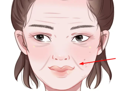 嘴角纹法令纹深怎么办？医生最常推荐的几种方案解析