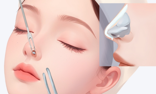 硅胶隆鼻和耳软骨隆鼻哪个好？做隆鼻前这几个关键区别你必须搞清楚